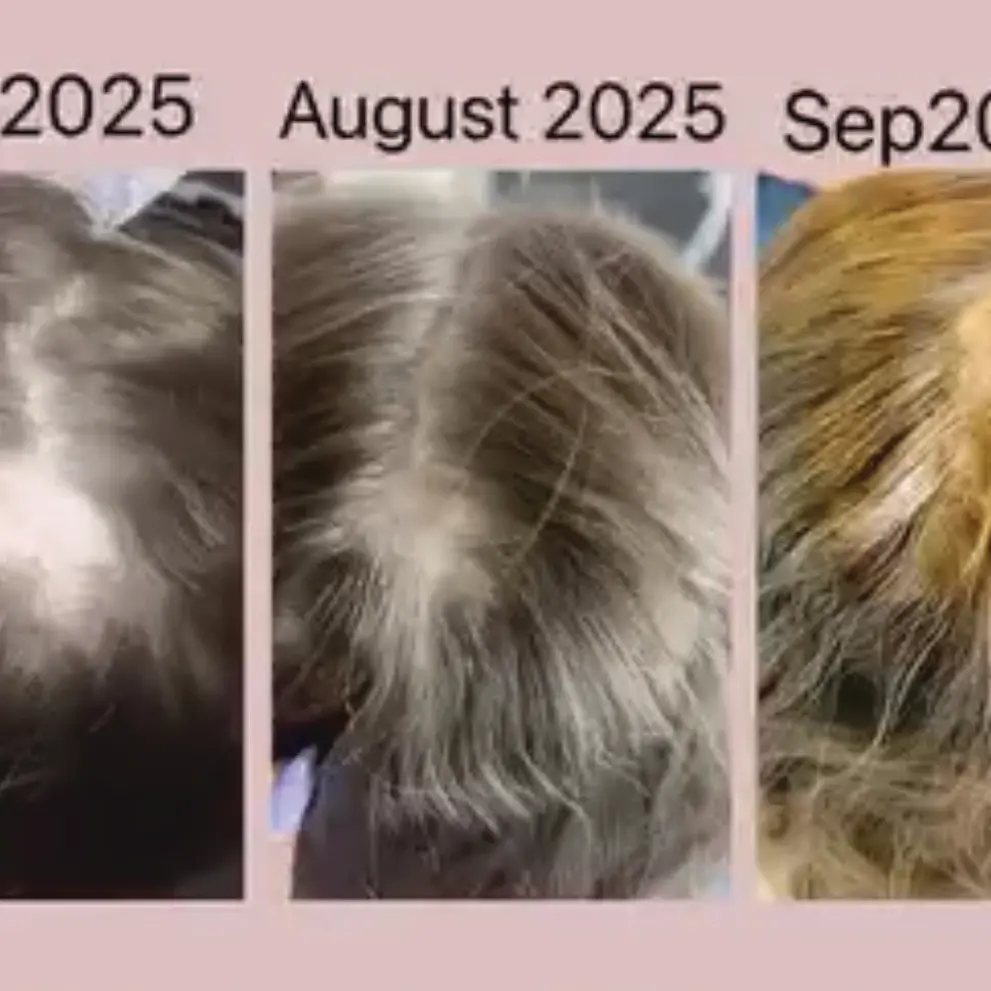 HairMantra: Confidence restored at HairMantra
